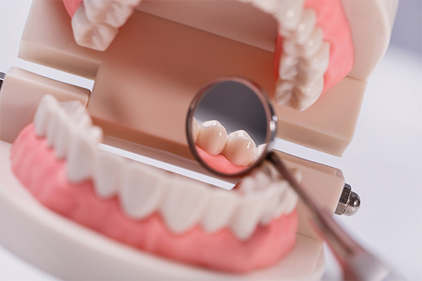 Dental Prosthesis